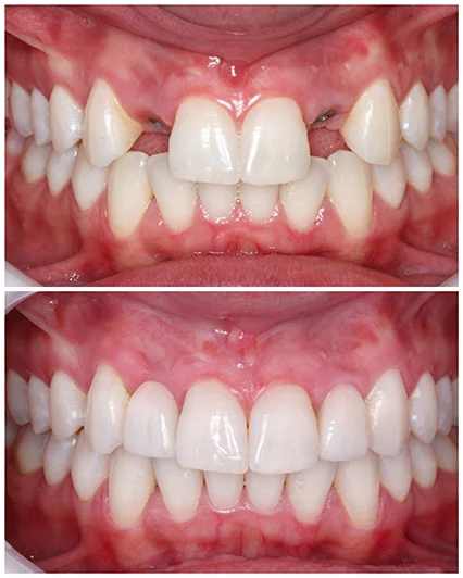 Clareamento e implantes Dentais: estética, saúde e segurança.