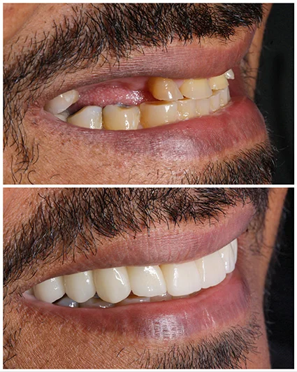 Implantes e facetas de porcelana: com um planejamento completo, sua vida também muda por completo.