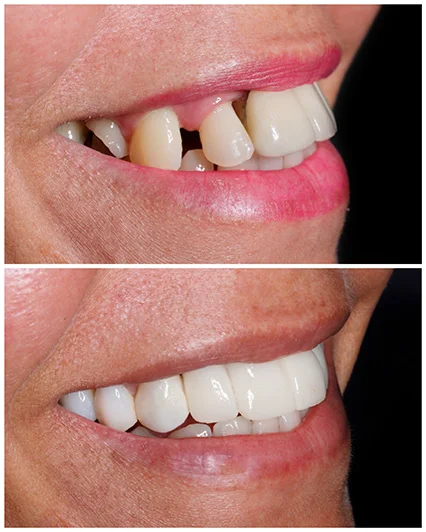 Implantes, facetas de porcelana e lentes de resina: transformação completa e sorriso renovado.