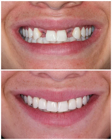 Clareamento e implantes dentais: recuperando auto-estima e eliminando o uso de próteses removíveis.