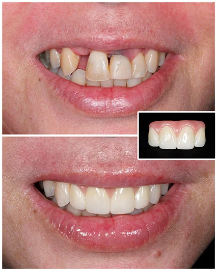 Implantes com recuperação de gengiva: muito mais que recuperar somente dentes!