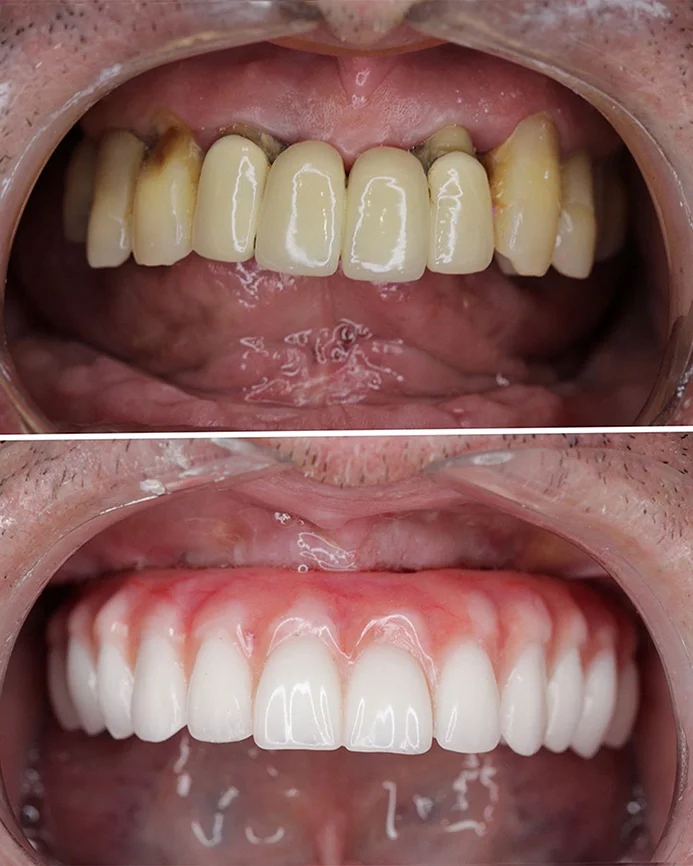 Prótese Protocolo Fixo sobre Implantes: jogue sua dentadura no lixo! Você pode sentir essa segurança!